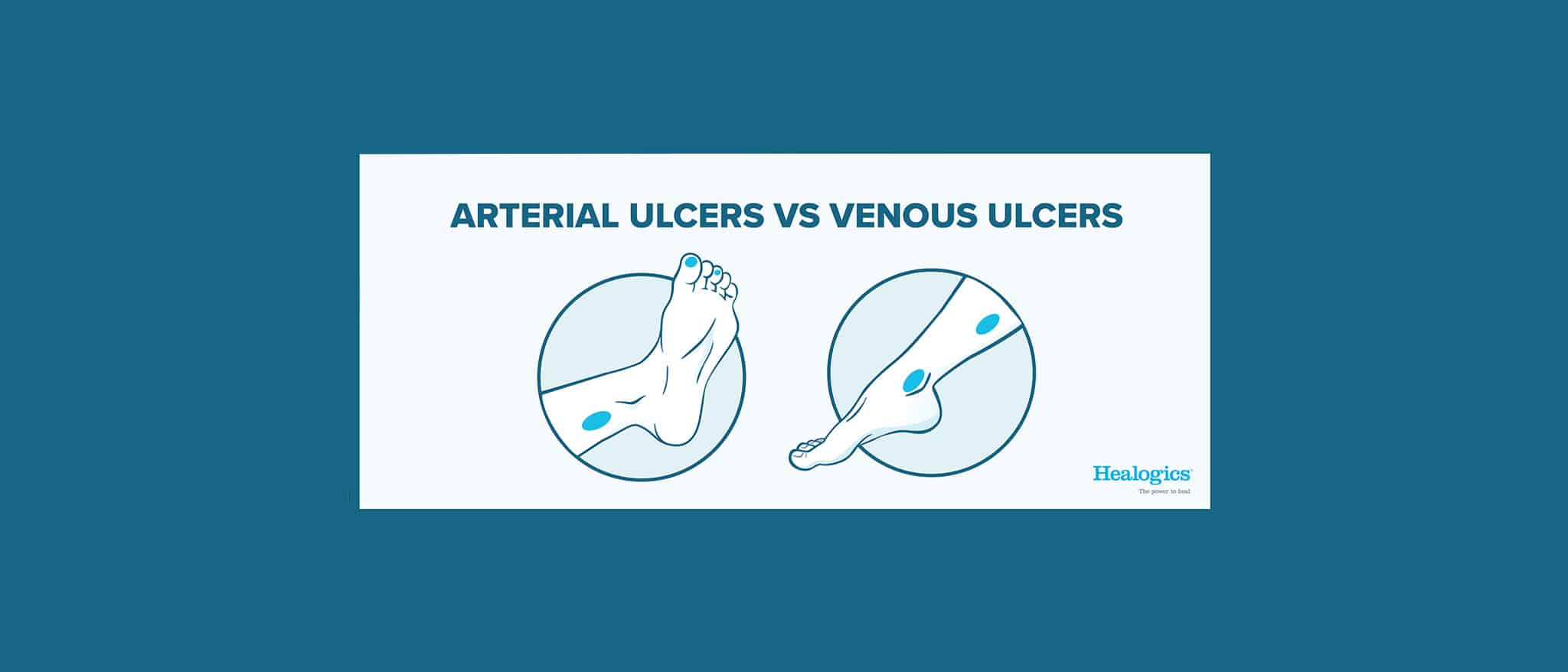 venous ulcer vs arterial ulcer